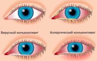 Кератоконъюнктивит код по мкб