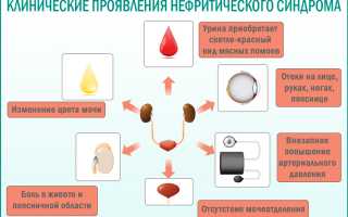Чем отличается нефротический синдром от нефритического таблица