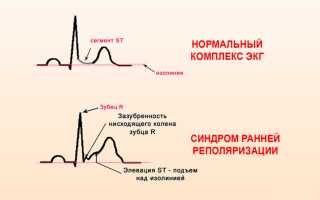 Синдром ранней реполяризации желудочков на экг и беременность