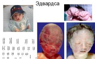 Синдром эдвардса фото детей с синдромом эдвардса