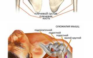 Синдром вращательной манжеты плеча лечение