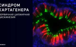 Синдром первичной цилиарной дискинезии применим к следующим состояниям