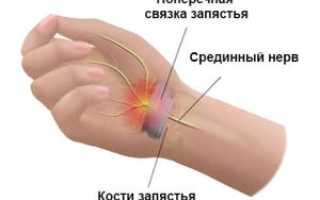 Туннельный синдром при беременности чем опасен