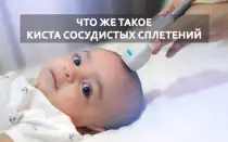 Киста сосудистого сплетения и синдром дауна