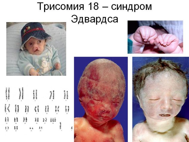 Синдром эдвардса фото детей с синдромом эдвардса
