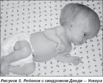 Что за синдром денди уокера