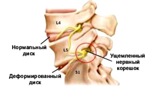 Лечение корешковый синдром при шейном остеохондрозе