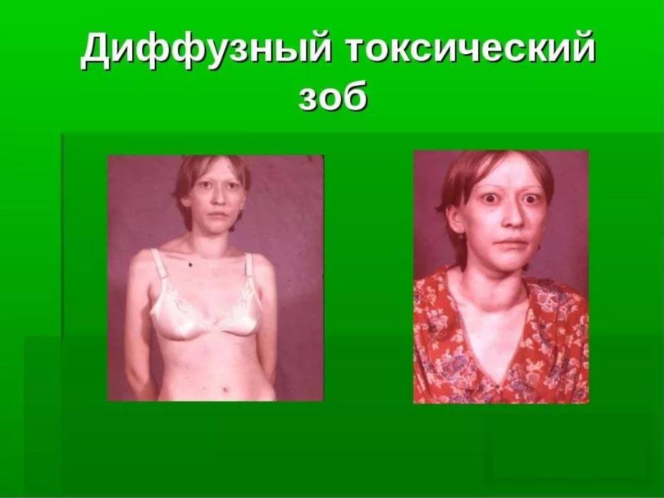 Диффузный токсический зоб