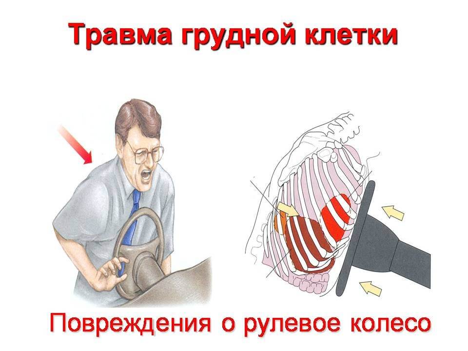 Ранение грудной клетки код мкб