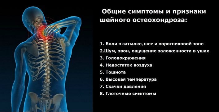 Лечение корешковый синдром при шейном остеохондрозе