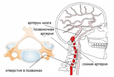 Методы лечения синдрома позвоночной артерии