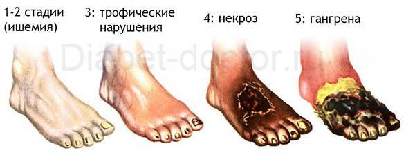 Сталиидии-стопы