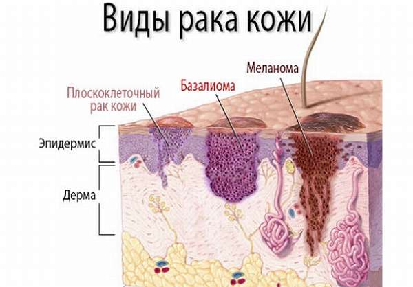 Код мкб рак кожи