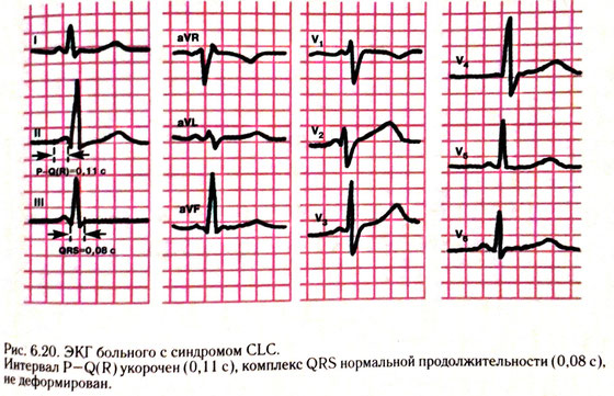 Экг синдром слс что это
