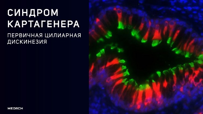 Синдром первичной цилиарной дискинезии применим к следующим состояниям