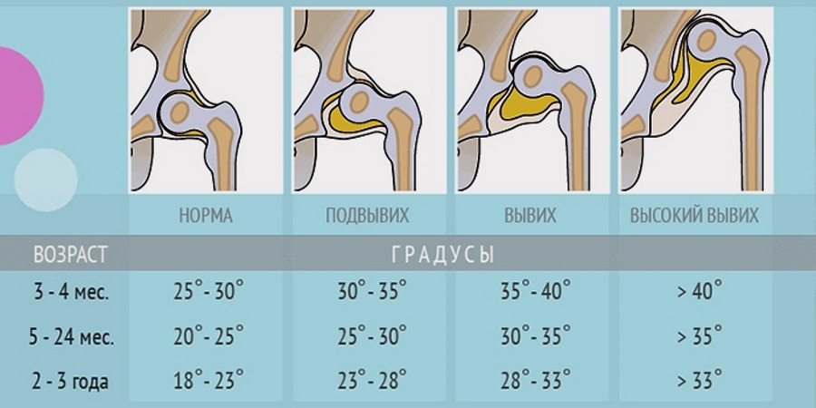 норма дисплазия тазобедренного сустава