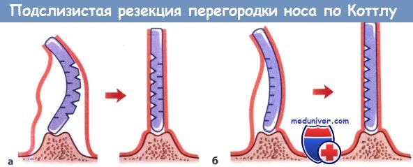 Техника подслизистой резекции перегородки носа по Коттлу