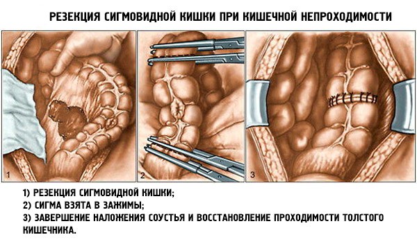 Резекция при острой кишечной непроходимости