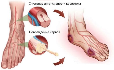 Синдром диабетической стопы лечение фото