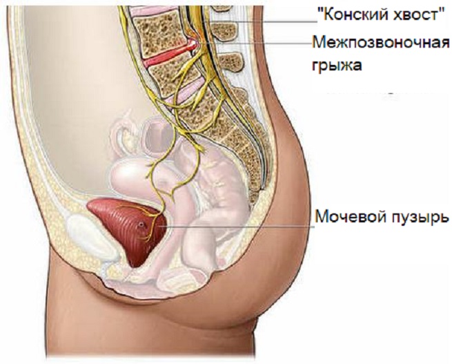 Народные средства для лечения синдрома конского хвоста