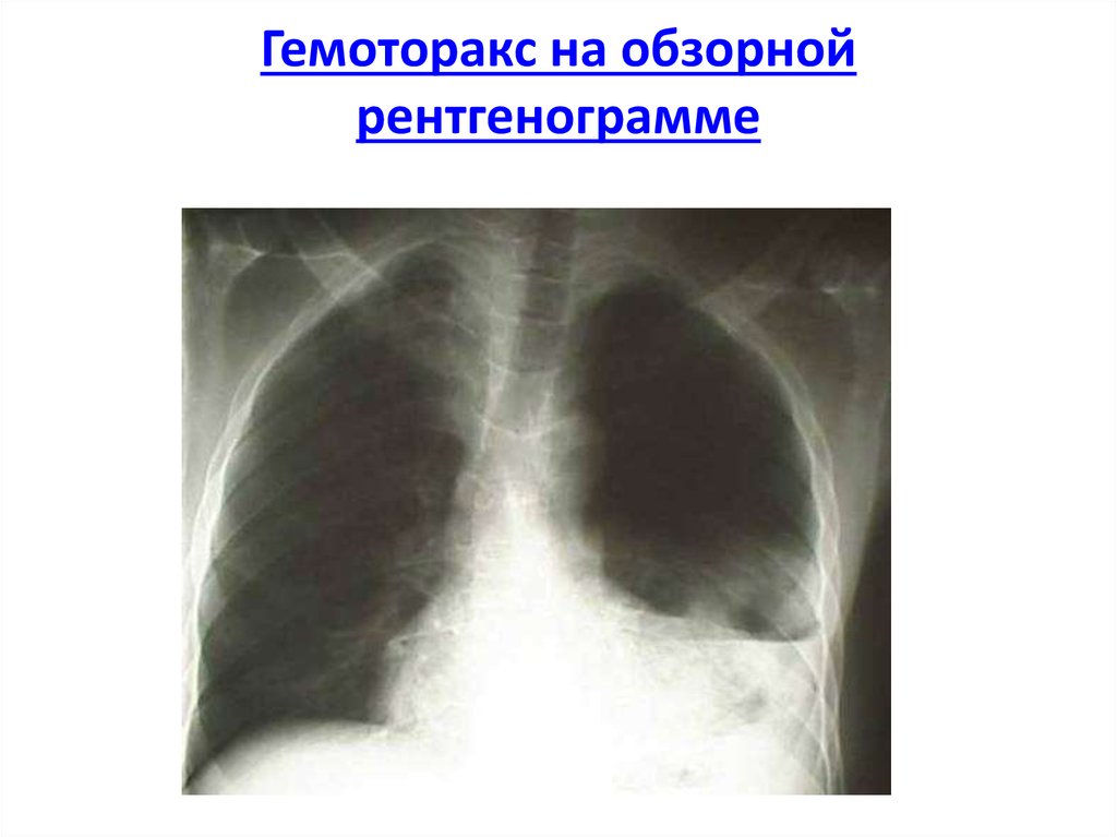 Ранение грудной клетки код мкб