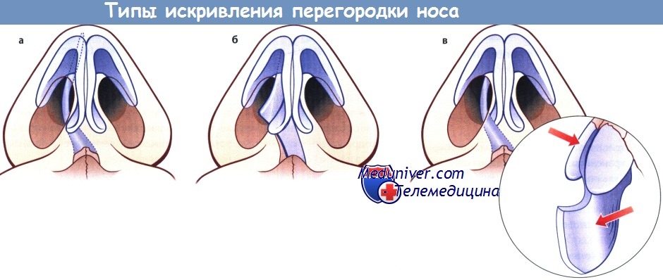 Типы искривления перегородки носа